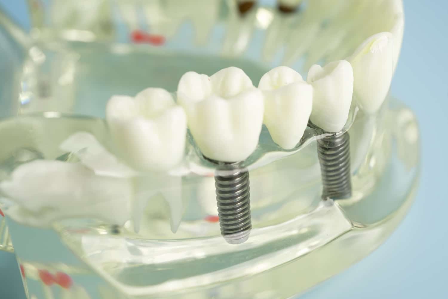 molar teeth dental implants